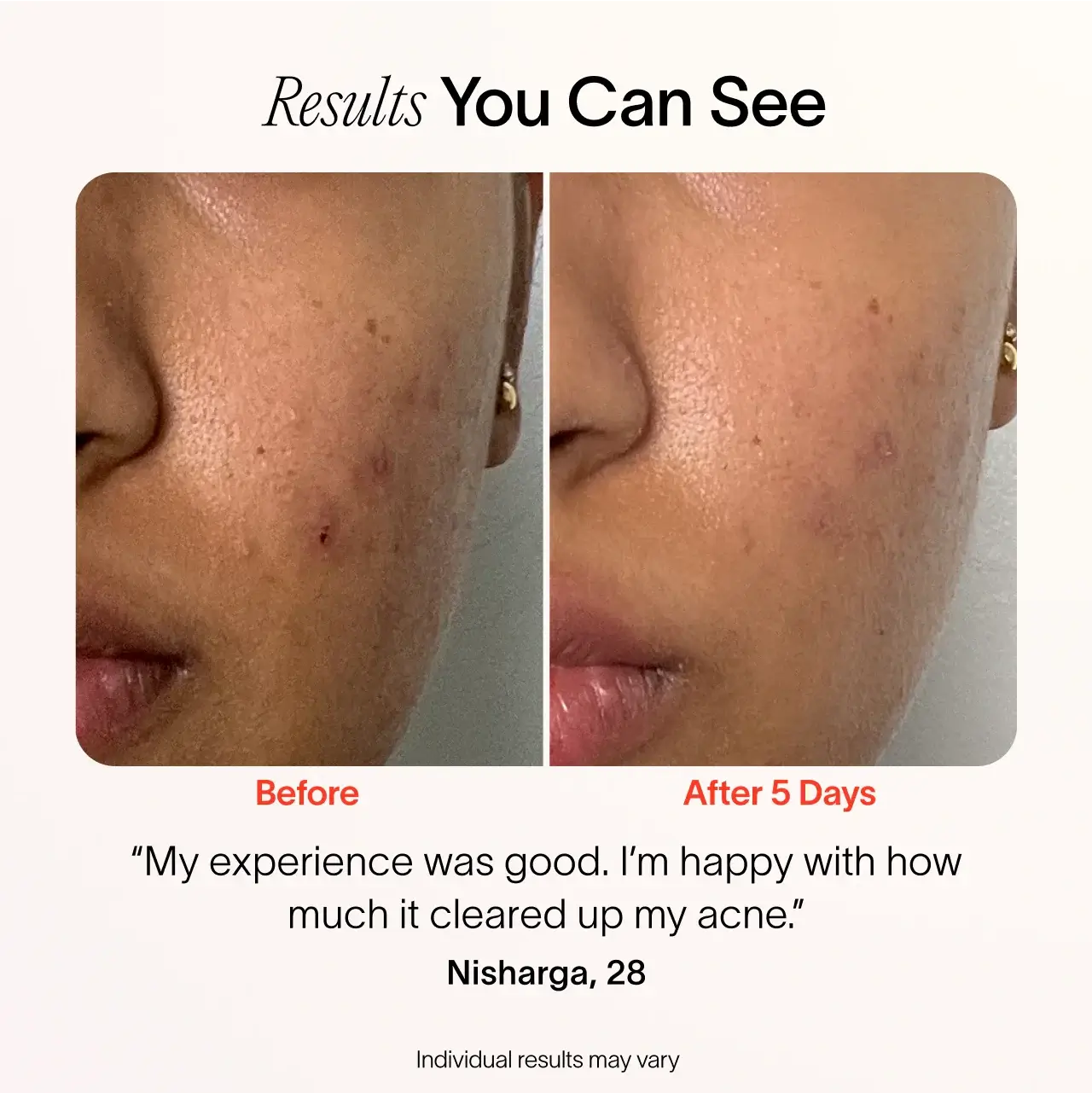 Bye Acne: 3-Minute Pimple Spot Treatment - Image 14