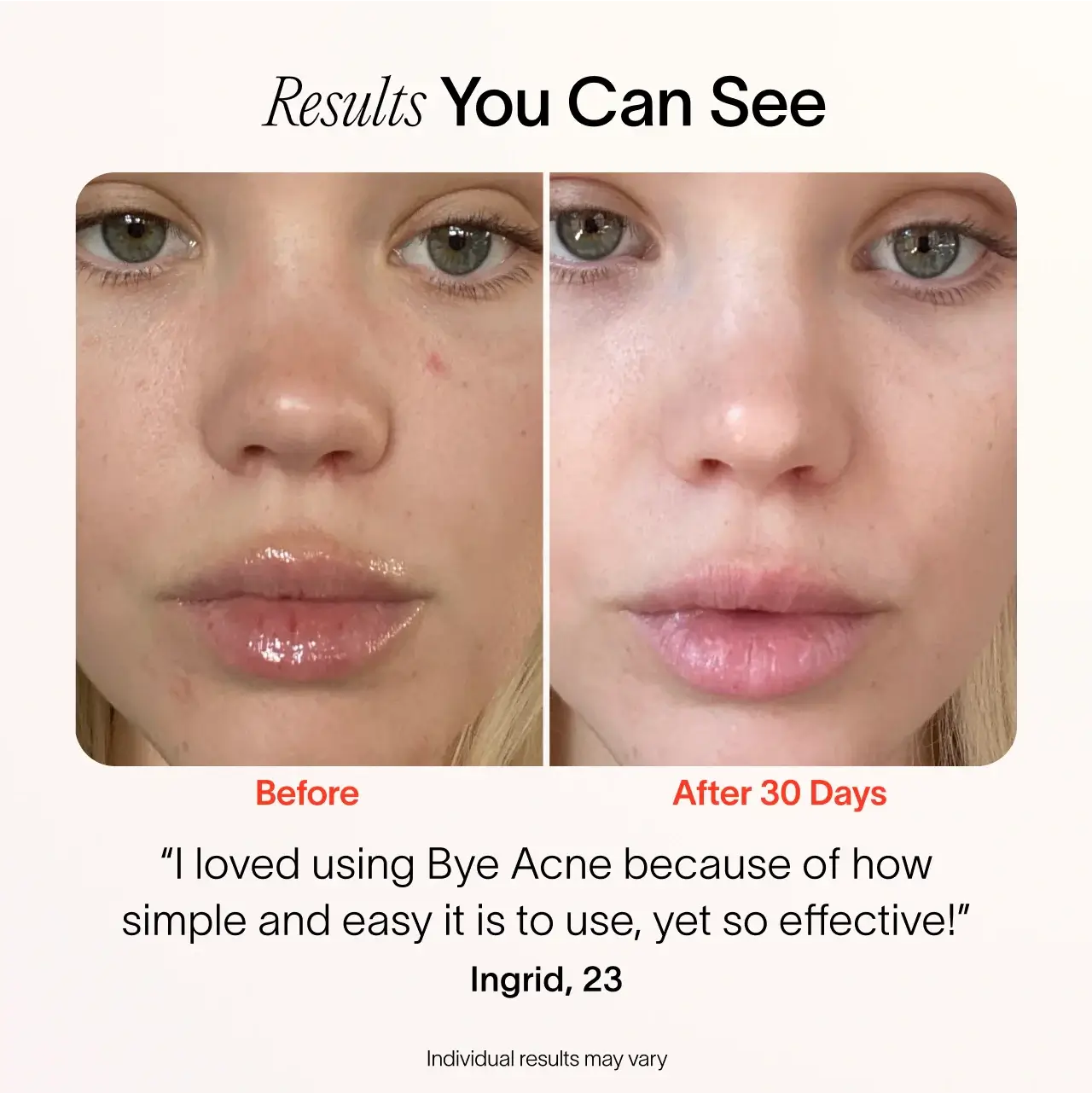Bye Acne: 3-Minute Pimple Spot Treatment - Image 7